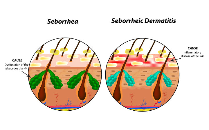 Causes Seborrhea for skin ,hair and dandruff seborrheic dermatitis