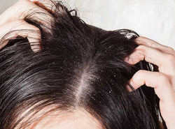 The Truth About Anti-dandruff Hair Oils - Dos & Dont's