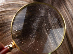 9 Ways To Get Rid Of Dandruff