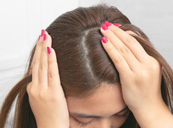 Dandruff Vs Psoriasis: What’s The Difference?