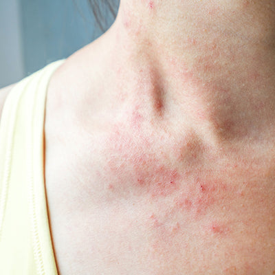 Skin Rash: An Emerging Symptom of Covid-19?