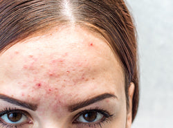 How To Treat Facial Acne Caused By Dandruff?