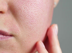 चेहरे के रोम छिद्र बंद करने के उपाय  - Open Skin Pores In Hindi