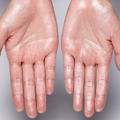 10 Solutions You Need To Treat Sweaty Hands