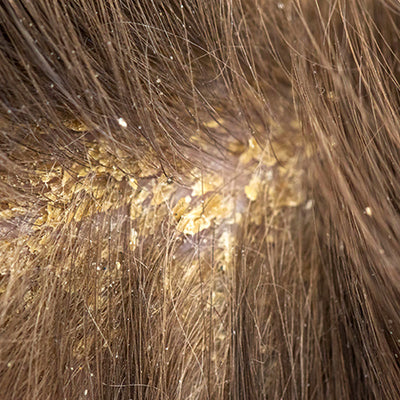 Sebum Build-Up On Scalp + How To Deal With It?