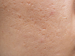 Ice Pick Acne Scars: Causes, Treatments & Prevention