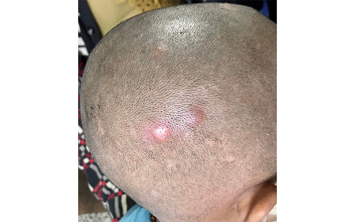 Numerous painful furuncles and folliculitis skin infection in scalp