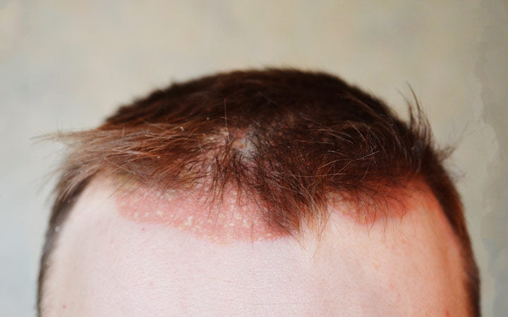 Psoriasis on scalp