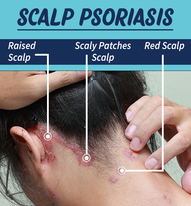 Woman showing back of the neck with scalp psoriasis