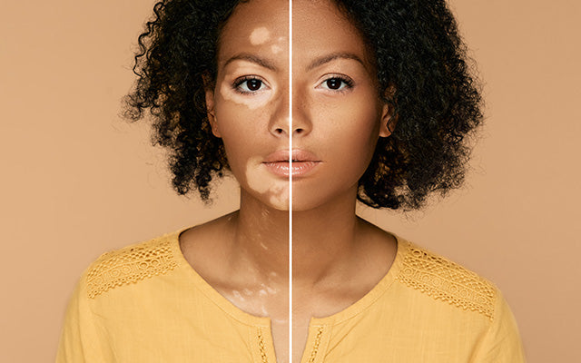 women without vitiligo