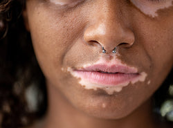 Vitiligo On Lips – Causes, Treatments & Useful Tips